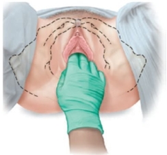 A pregnant patient is having pelvic measurements made. Which approach should the examiner use to determine this patient's estimated length of the pubic ramus? A) B) C) D)