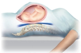 A pregnant patient is observed lying in bed in the following position. Which health problem is this patient prone to developing?   A)  Vena caval syndrome B)  Physiologic anemia of pregnancy C)  Physiologic leukocytosis D)  Low iron level