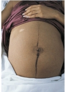 During a routine assessment of a pregnant patient the nurse observes the following on the patient's abdomen. How should the nurse document this finding?   A)  Striae B)  Chloasma C)  Linea nigra D)  Vascular spider nevi