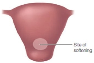During a pelvic examination of a pregnant patient the following area is identified as being softened. How should the nurse document this finding?   A)  Ladin sign B)  Braun von Fernwald sign C)  Piskacek's sign D)  Goodell sign