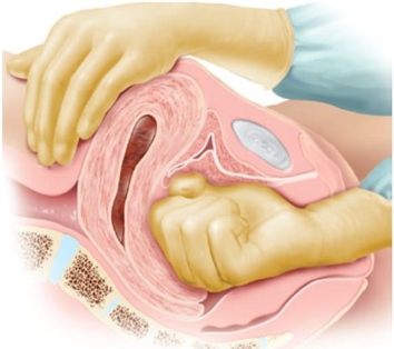 The nurse provides a postpartum patient with the following diagram. For which procedure is the nurse preparing this patient?   A)  Uterine tamponade B)  Manual removal of the placenta C)  B-Lynch compression procedure D)  Manual compression of the uterus