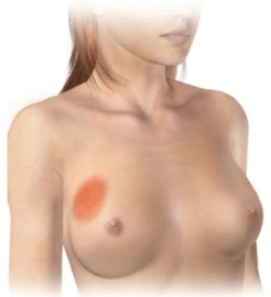 The nurse selects the following diagram to take when making a home visit to a postpartum patient. For which health problem is the nurse preparing educational material?   A)  Cystitis B)  Metritis C)  Mastitis D)  Parametritis