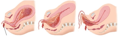 The nurse is assisting in the delivery of a pregnant patient's placenta post-delivery. The placenta appears as follows. What term should the nurse use to document this placental delivery?   A)  Schultz mechanism of delivery B)  Duncan mechanism of delivery C)  Complete mechanism of delivery D)  Incomplete mechanism of delivery
