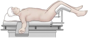 A patient is undergoing a surgical procedure. Based on the figure, which intraoperative position does this represent?   A) Fowler's B) Low lithotomy C) Supine D) Trendelenburg