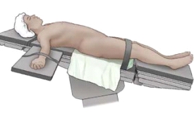 A patient is undergoing a surgical procedure. Based on the figure, which intraoperative position does this represent?   A) Fowler's B) Jackknife C) Reverse Trendelenburg D) Trendelenburg