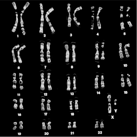 Which of the following is true of the genetic cross shown in the figure below?   A)  All of their daughters will be carriers. B)  Their sons have a 50 percent chance of being carriers. C)  Their sons have a 50 percent chance of having the disorder. D)  Their daughters have a 50 percent chance of having the disorder.