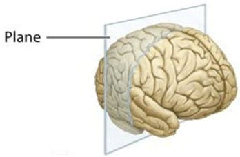   In this figure, the plane of section divides the brain into ________ parts. A) anterior and posterior B) superior and inferior C) medial and lateral D) proximal and distal
