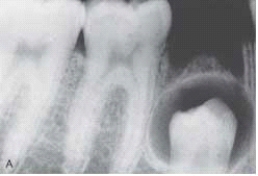   This unilocular radiolucency around the crown of an unerupted second premolar is most likely a: A)  normal developmental sac. B)  dentigerous cyst. C)  primordial cyst. D)  lateral periodontal cyst.