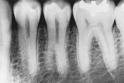   The developmental anomaly seen in this radiograph is: A)  taurodontism. B)  mulberry molar. C)  supernumerary roots on the premolars. D)  dilaceration.