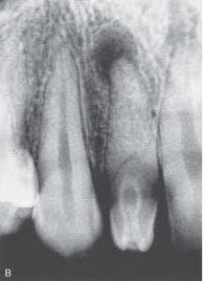   This radiograph clearly shows which developmental anomaly? A)  Dens in dente B)  Periapical (PAP)  C)  Caries D)  Open contacts