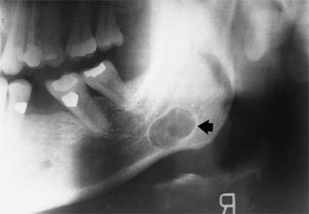   The pseudocyst seen in this radiograph is surrounded by salivary gland tissue. It is a/an: A)  simple bone cyst. B)  Stafne bone cyst. C)  traumatic bone cyst. D)  aneurysmal bone cyst.