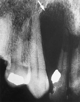   The pear-shaped radiolucency observed in this radiograph is most likely a: A)  radicular cyst. B)  lateral periodontal cyst. C)  globulomaxillary cyst. D)  nasopalatine canal cyst.