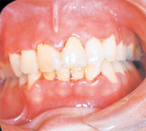   The gingivae are painful and erythematous. The interdental papillae appear as punched-out, necrotic, cratering areas. The overall sloughing of the necrotic tissue appears as a pseudomembrane over the tissues. The patient experiences a foul odor and metallic taste. On the basis of these features you suspect that this patient has: A)  acute marginal gingivitis. B)  primary herpes infection. C)  necrotizing ulcerative gingivitis. D)  pseudomembranous candidiasis.