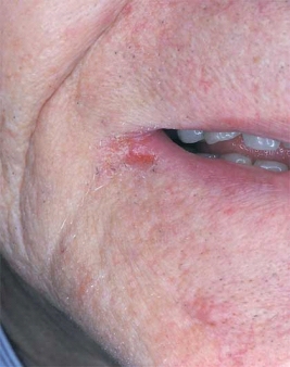   This lesion in the commissure is most likely caused by Candida albicans or a nutritional deficiency. A)  Pseudomembranous candidiasis B)  Angular cheilitis C)  Chronic mucocutaneous candidiasis D)  Chronic atrophic candidiasis