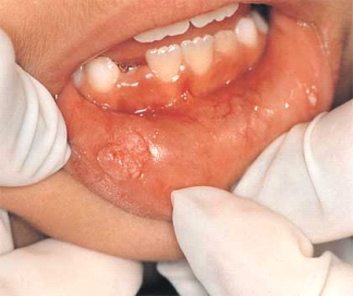 <strong>  The illustration shows an oral condyloma acuminatum presenting in a child. The presence of condyloma acuminatum in a child suggests:</strong> A) hypersensitivity. B) genetic predisposition. C) sexual abuse. D) autoimmune disease. <div style=padding-top: 35px> 