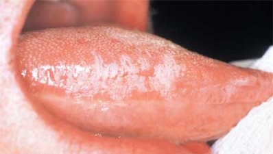   The most reliable method of diagnosis for this condition of the tongue is the isolation of the Epstein-Barr virus. A)  White hairy tongue B)  Hairy leukoplakia C)  Mononucleosis D)  Kaposi sarcoma