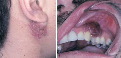   Name the vascular lesion that is seen in this illustration. The patient is HIV seropositive. The most common intraoral locations are the gingiva and palate. When diagnosed, this vascular lesion meets the criteria for the diagnosis of acquired immune deficiency syndrome (AIDS) . The most common locations are the gingiva and palate. A)  Non-Hodgkin lymphoma B)  Kaposi sarcoma C)  Thrombocytopenia D)  Hemangioma
