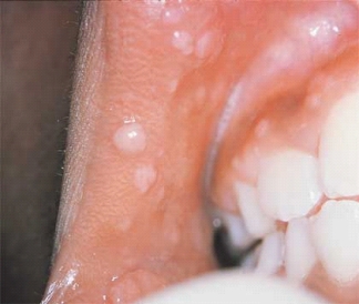 <strong>  Which of the lesions seen in this illustration is the lesion seen LEAST commonly in HIV patients?</strong> A) Candidiasis B) Hairy leukoplakia C) Herpes simplex D) Heck disease <div style=padding-top: 35px> 