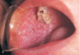   The classic appearance of this condition is a patterrn of interconnecting slender lines referred to as Wickham striae. A)  Lichen planus B)  Linea alba C)  Erythema multiforme D)  Reiter syndrome