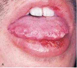  The onset of this condition is explosive. It is characterized by skin and mucosal lesions. The skin lesions are referred to as target, iris, or bull's eye lesions. The mucosal lesions affect the buccal mucosa, lips, and tongue and appear as superficial ulcerations. The lip lesions are ulcerated, encrusted, and bloody. On the basis of this description, you suspect: A)  lichen planus. B)  erythema multiforme. C)  contact dermatitis. D)  SLE.