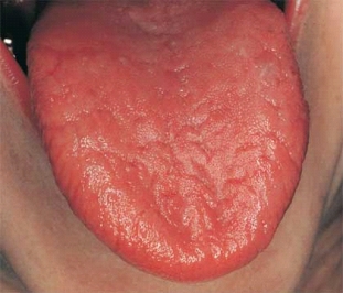   This patient has Sjögren syndrome and severe xerostomia. Which of the following is the clinical feature that most appropriately describes the changes on the tongue in this patient? A)  Dryness B)  Candidiasis C)  Loss of filiform and fungiform papillae D)  Fissures