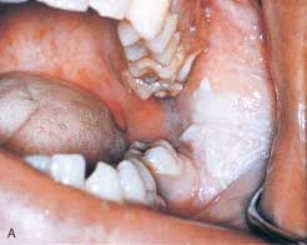   This patient comes to the office as an emergency. The patient complains of a toothache in the left mandibular posterior area. On clinical examination you notice a gray-to-white patch on the left posterior buccal mucosa. On questioning the patient tells you that this area is also painful. After reviewing the patient's medical history, you question the patient regarding his recent use of: A)  hydrogen peroxide. B)  aspirin. C)  antibiotics. D)  mouthwash.