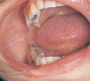   This white raised line observed anterior-posterior on the buccal mucosa along the occlusal plane is: A)  cheek biting B)  linea alba. C)  white sponge nevus. D)  frictional keratosis.