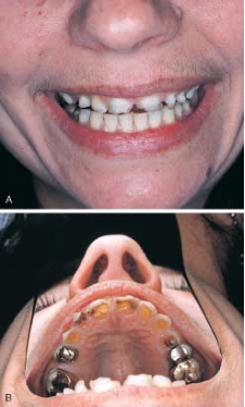   This type of erosion is classically associated with: A)  anorexia nervosa. B)  bulimia. C)  sucking lemons. D)  abrasive toothpaste.