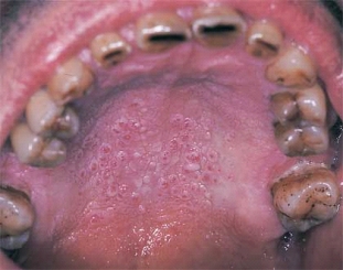   This lesion on the palate typically is associated with heavy pipe and cigar smoking. A)  Tobacco pouch keratosis B)  Necrotizing sialometaplasia C)  Nicotine stomatitis D)  Frictional keratosis
