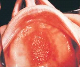   This granular, erythematous papillary surface of the palatal vault was caused by: A)  poor oral hygiene. B)  an ill-fitting suction area of the denture. C)  the denture flange. D)  soaking the denture in caustic rinses.