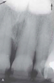   This bony hard radiopaque structure in the midline of the hard palate is genetic and autosomal dominant. The diagnosis is made through clinical diagnosis. You suspect a: A)  palatal cyst. B)  torus palatinus. C)  mixed tumor. D)  ranula.
