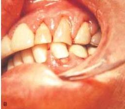   The gingival enlargement in this patient was caused by a calcium channel blocker. Which one of the following would likely be the cause? A)  Dilantin B)  Cyclosporine C)  Procardia D)  Clozapine