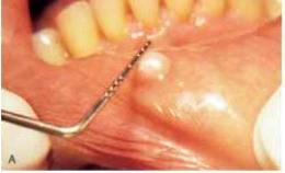   The base of this lesion would be described as: A)  pedunculated. B)  a lobule. C)  a bulla. D)  sessile.