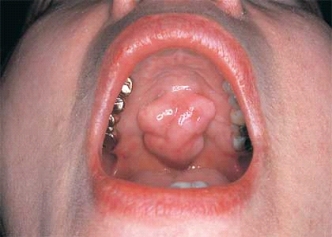   This torus palatinus would be described as: A)  bullous. B)  a papule. C)  lobulated. D)  a nodule.