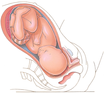 Which stage of labor is depicted here?   A)  Dilation B)  Expulsion C)  Placental D)  Birth