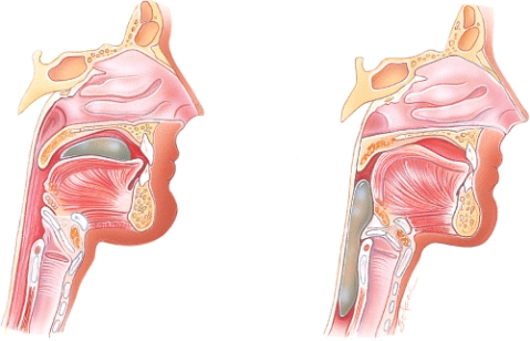 Which stage of swallowing is shown here?   A)  Voluntary stage B)  Pharyngeal stage C)  Esophageal stage D)  Pyloric stage
