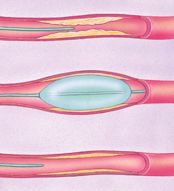 What is the name of this procedure?   A)  By-pass surgery B)  Placement of a stent C)  Balloon angioplasty D)  Defibrillation