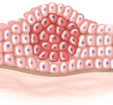 The tumor in the illustration is:   A) malignant. B) metastatic. C) benign. D) exhibiting contact inhibition.