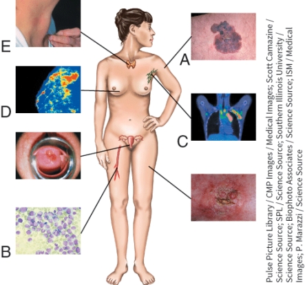 Leukemia is indicated by which letter in the picture?   A)  A B)  B C)  D D)  E