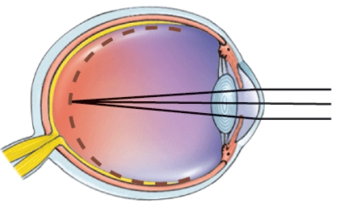 What is this a picture of?   A)  Nearsightedness B)  Farsightedness C)  Astigmatism D)  Normal vision