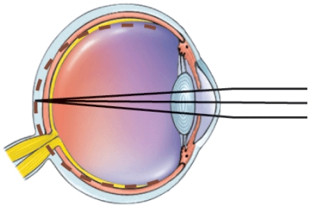 What is this a picture of?   A)  Nearsightedness B)  Farsightedness C)  Astigmatism D)  Normal vision