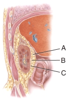 This layer runs deep to the peritoneum and anchors the kidney to the surrounding structures and to the abdominal wall.    A)  A B)  B C)  C D)  B and C E)  All of these answer choices are correct.