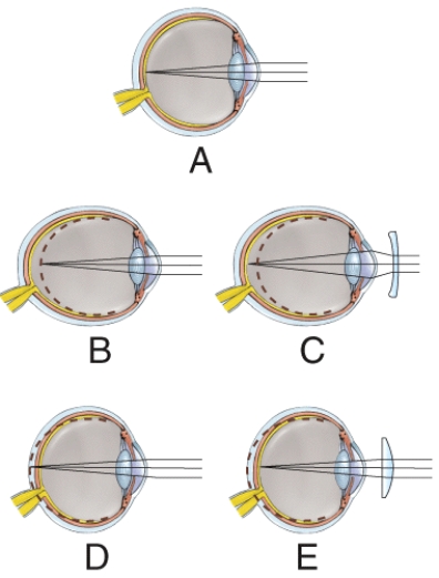Which one demonstrates farsightedness before it has been corrected?   A)  A B)  B C)  C D)  D E)  E