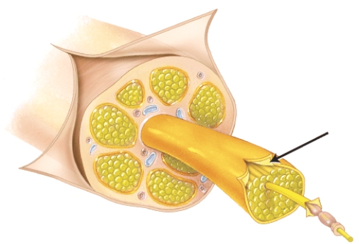 The connective tissue sheath around a group of neuronal fibers (a fascicle)  is called the   A)  endoneurium. B)  perineurium. C)  epineurium. D)  fasciculus.