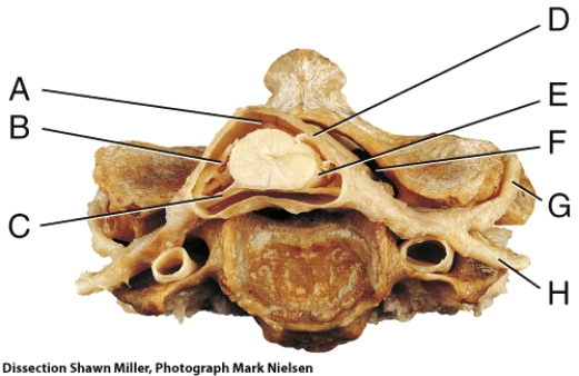 Where is the epidural space?   A)  A B)  D C)  E D)  F E)  G