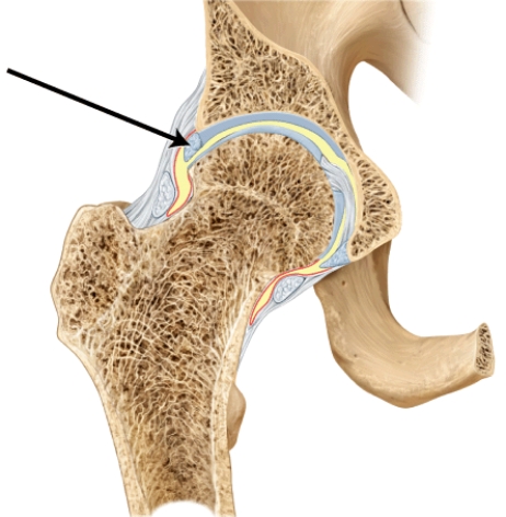 Which of the following statements is FALSE regarding this structure?    A)  It is called the acetabular labrum. B)  It is composed primarily of fibrocartilage. C)  It contributes to the stability of the hip joint. D)  It is enclosed within the articular capsule. E)  It is a bony lip that extends around the head of the femur.