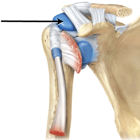 Identify this structure.   A)  subdeltoid bursa B)  subcoracoid bursa C)  subscapular bursa D)  subacromial bursa E)  suprapatellar bursa
