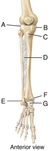 Identify the structures that articulate with the condyles of the femur to form the tibiofemoral joint.   A)  A and B B)  B and C C)  A and C D)  E and F E)  F and G
