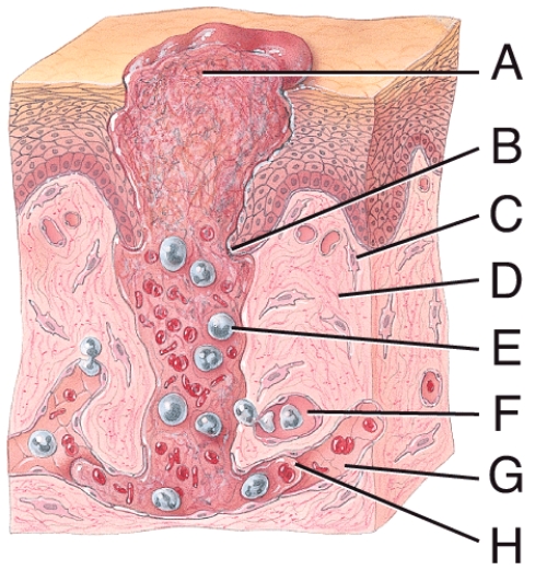 In the diagram of the inflammatory phase of deep wound healing, where is the blood clot?   A)  A B)  C C)  D D)  G E)  H