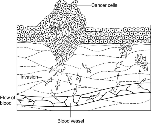   Which one of the following is shown in the figure above? A)  in situ cancer B)  death of a neoplasm C)  metastatic tumor D)  benign tumor E)  precancerous mass of cells